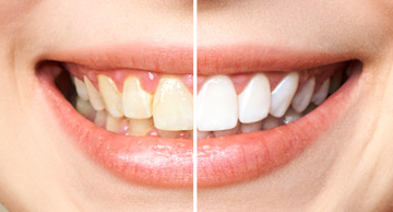 שינוי בצבע השיניים כתוצאה מרשלנות רפואית